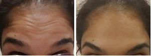 Forehead Lines Botox, before and after