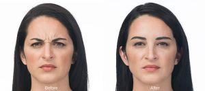 Forehead Lines Botox, before and after