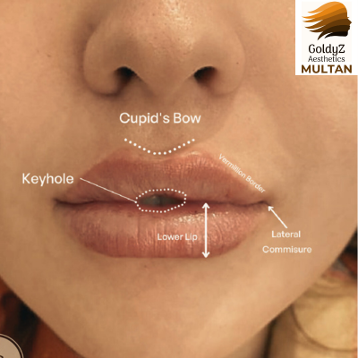 Keyhole Pout Lip Fillers