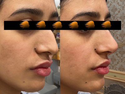 Nose Tip Lift by botox injection