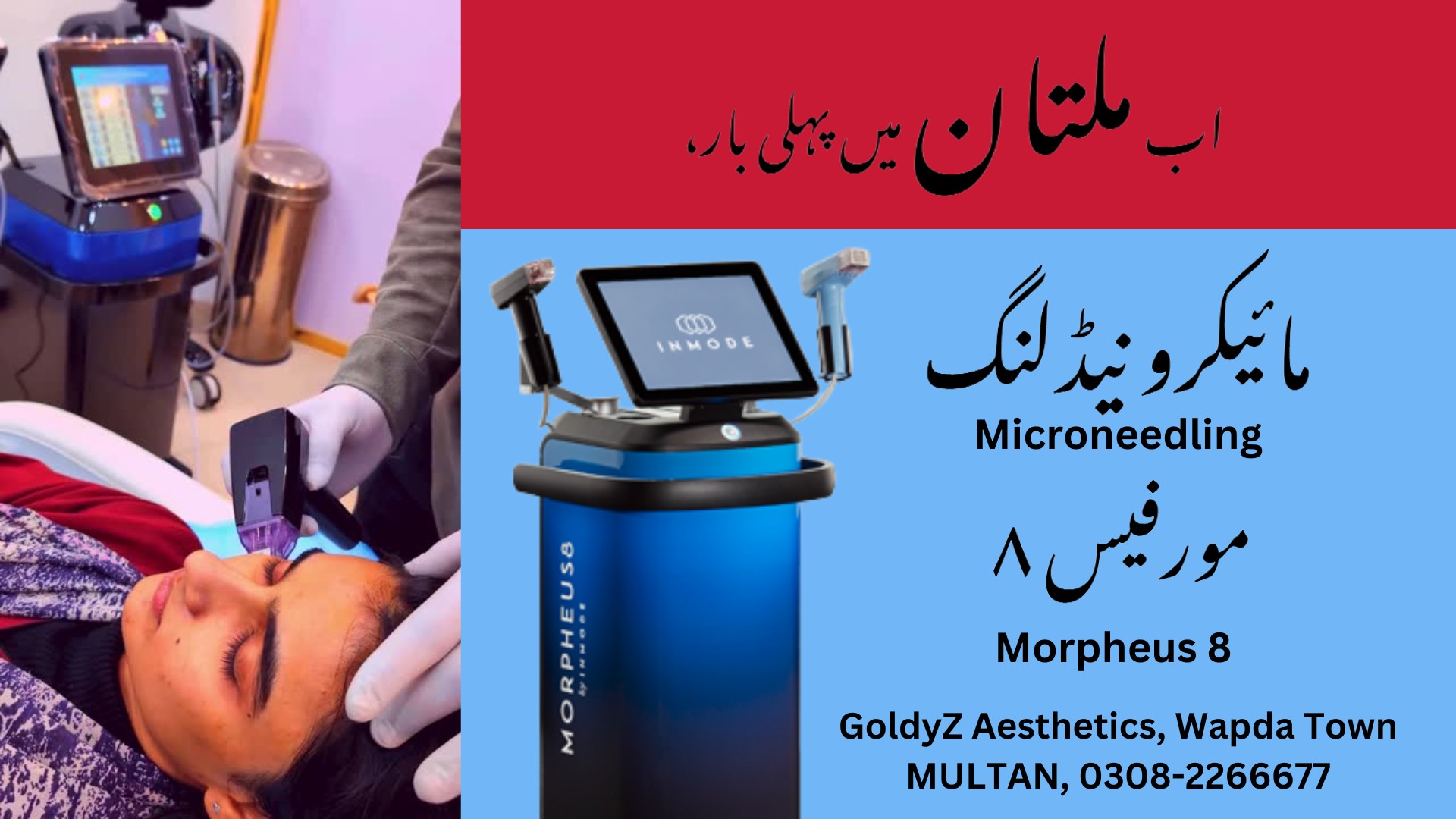 Morpheus 8 Microneedling with RF